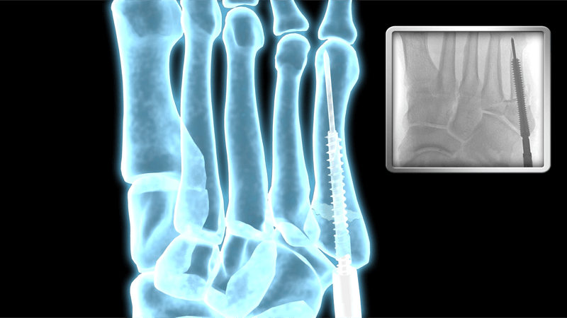 Fluoroscopic-style foot render