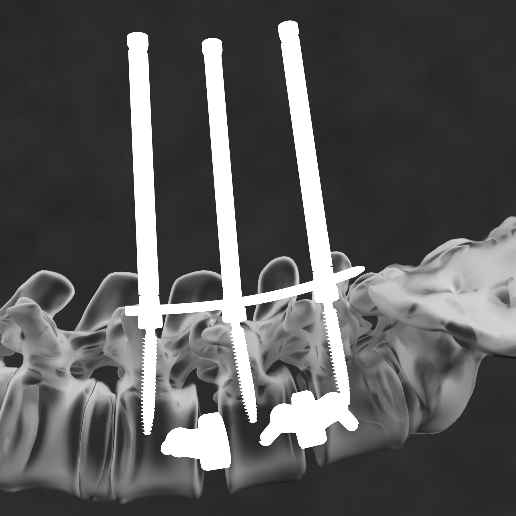 Spine procedure image with medical device