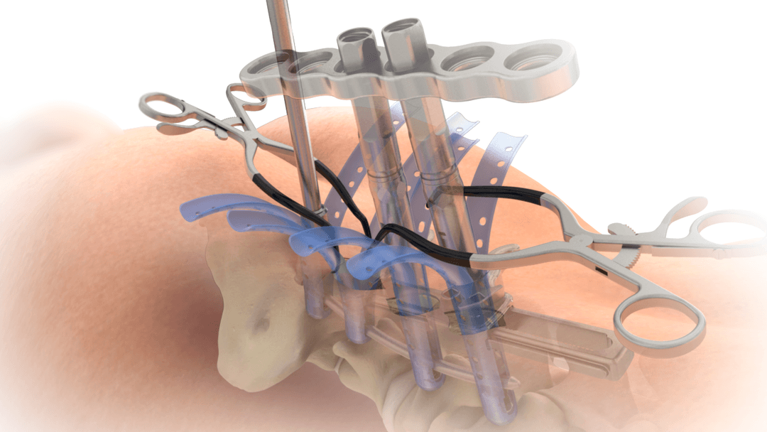 Retractor system render on a patient model