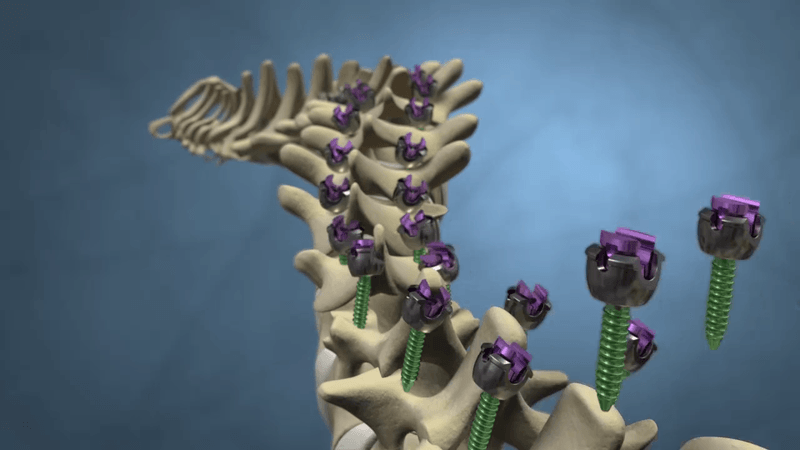 Pedicle screw range render