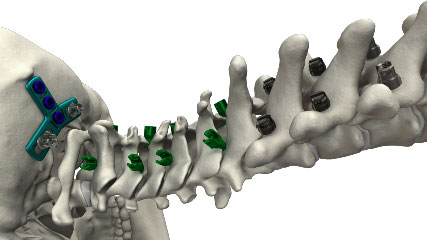 Occipitocervical fixation construct from the skull base down the cervical spine