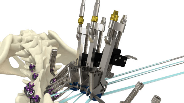 Surgical device with screws and rods attached to a section of a human spine model.