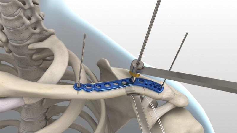 Blue bone plate fixed across a clavicle with guide wires in place