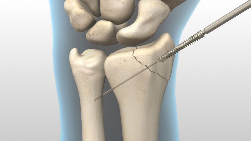 Headless compression screw placed across a bone fracture line