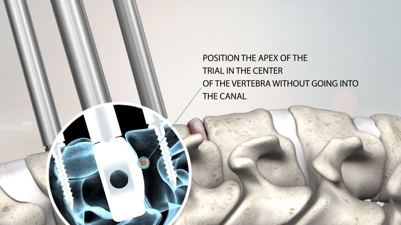Cervical disc trial being positioned, with a fluoroscopic inset and placement instructions