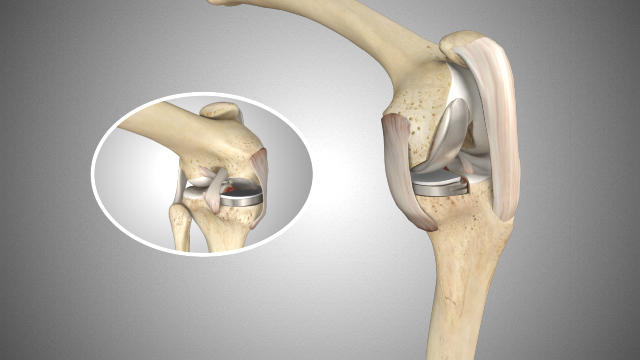 Unicompartmental knee implant in the joint with a magnified detail inset