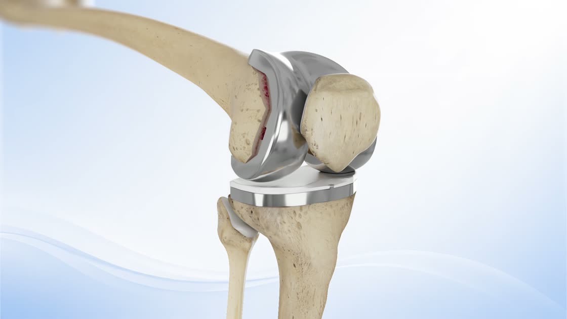 A frame from a Pulse 3D animation showing a completed total knee replacement implant in place.