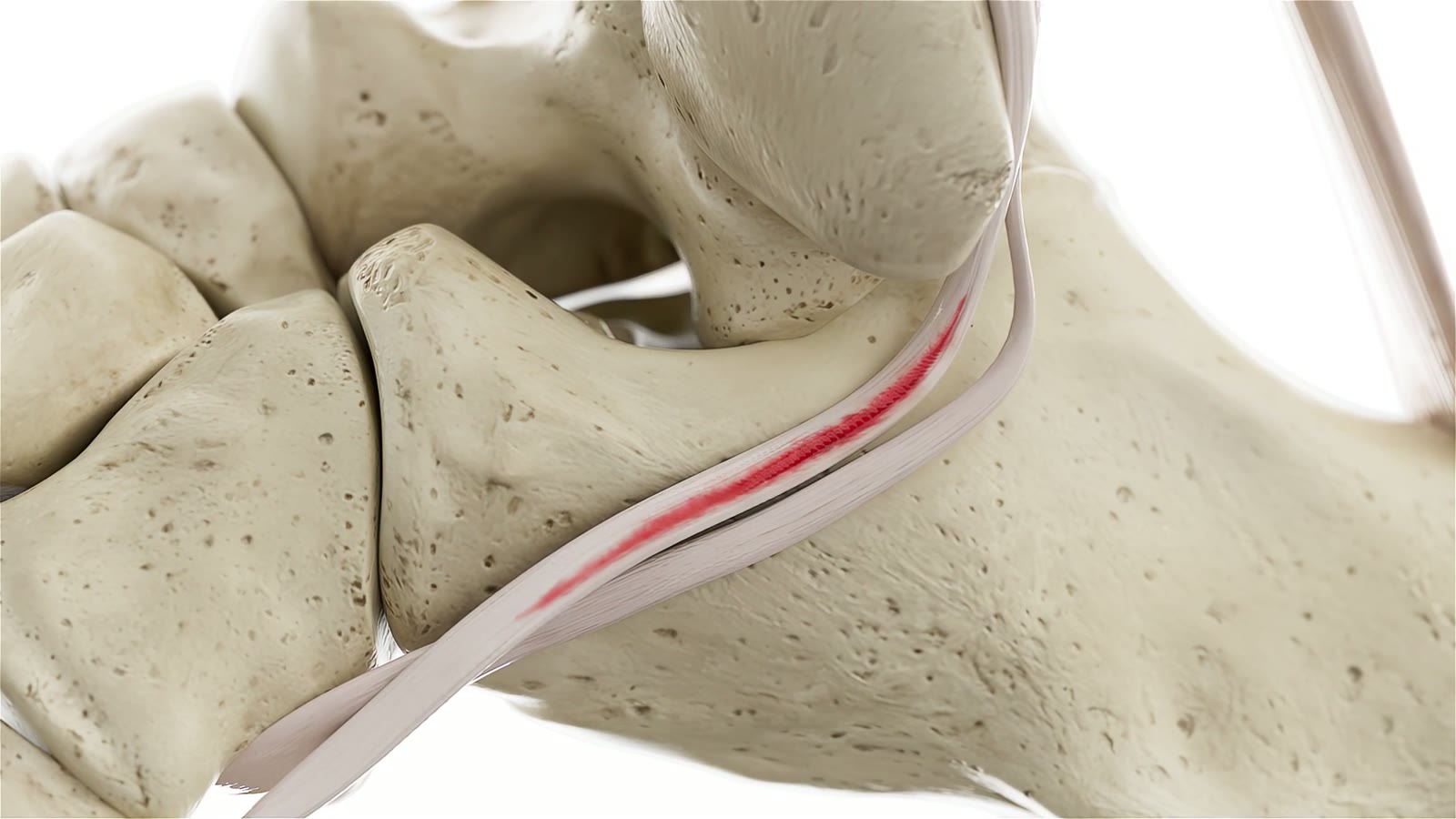 Torn tendon, the clinical problem the device addresses