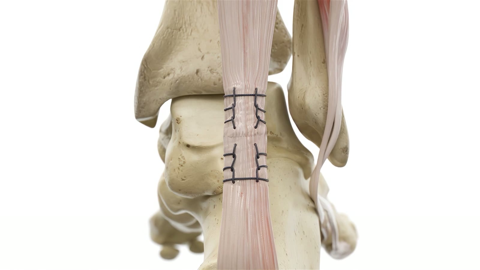 Wide frame from a surgical technique animation of an Achilles repair