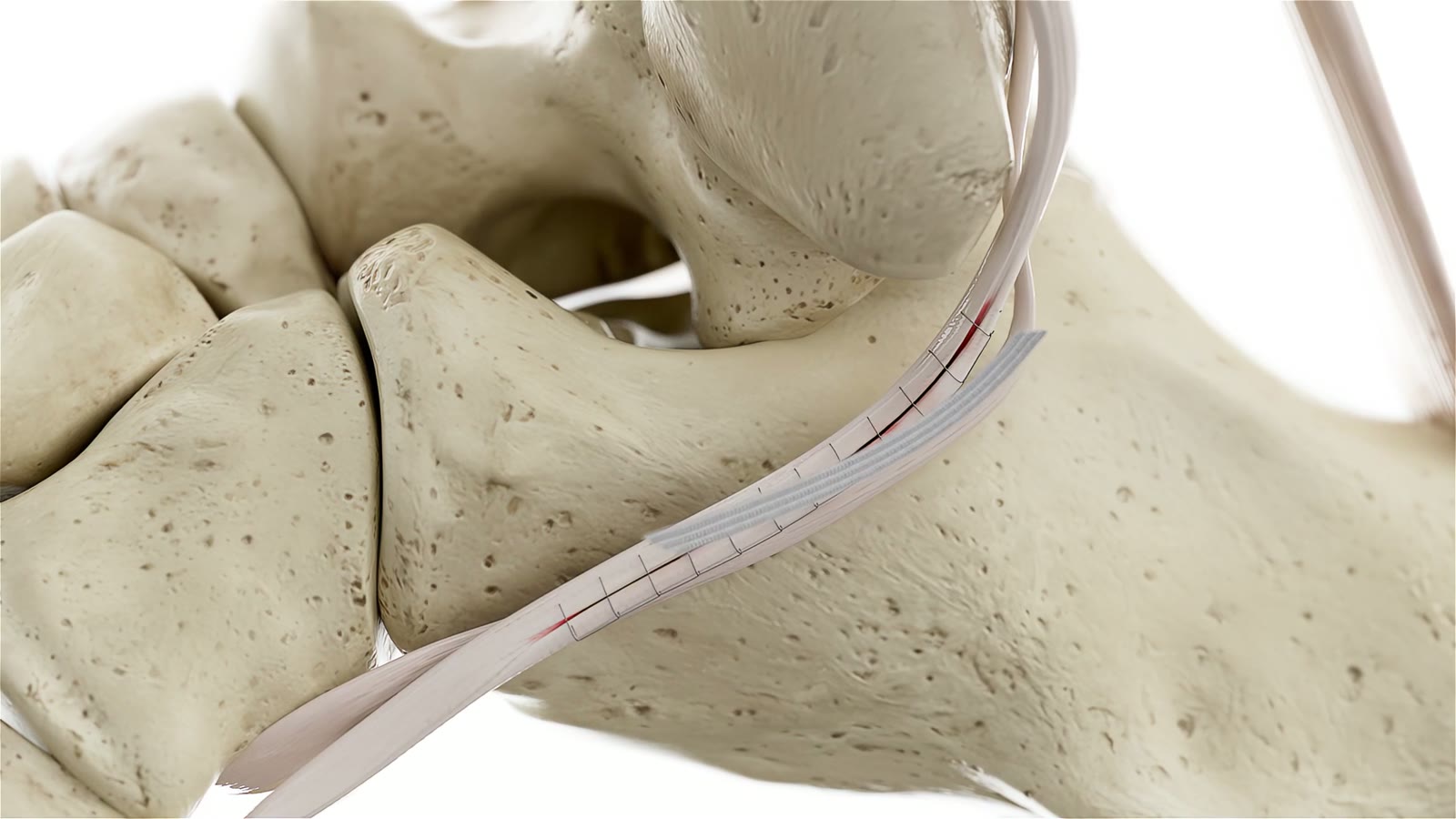 Suturing the repair device to the tendon