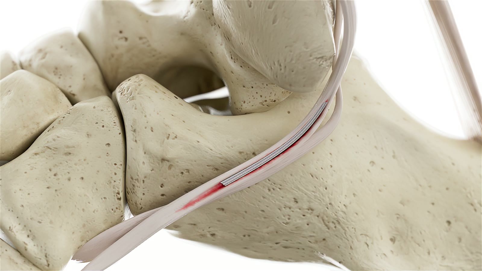 The repair device positioned on the tendon