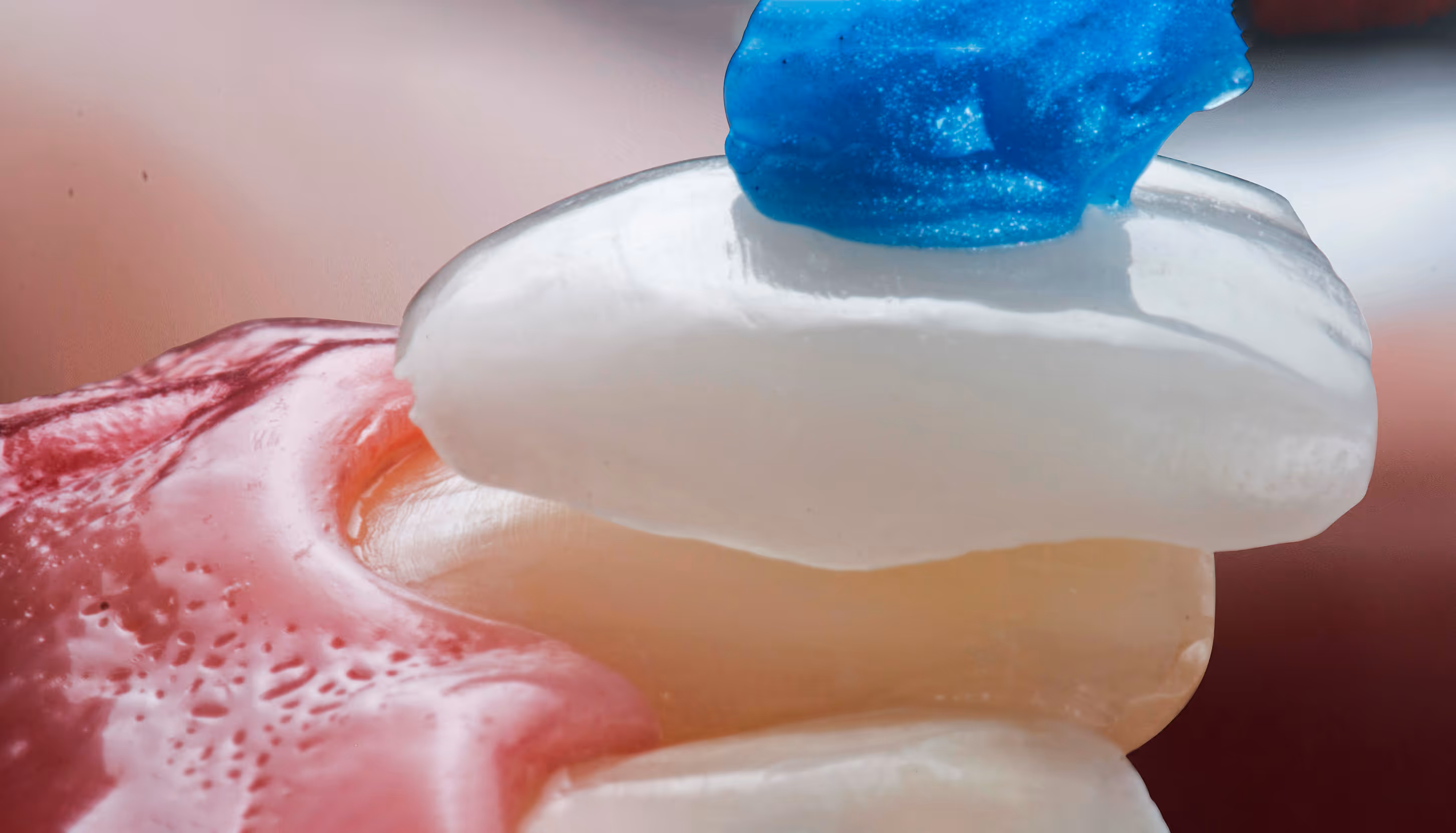 Zahnbehandlung mit blauem Applikator auf einem Frontzahn nahe dem Zahnfleisch.