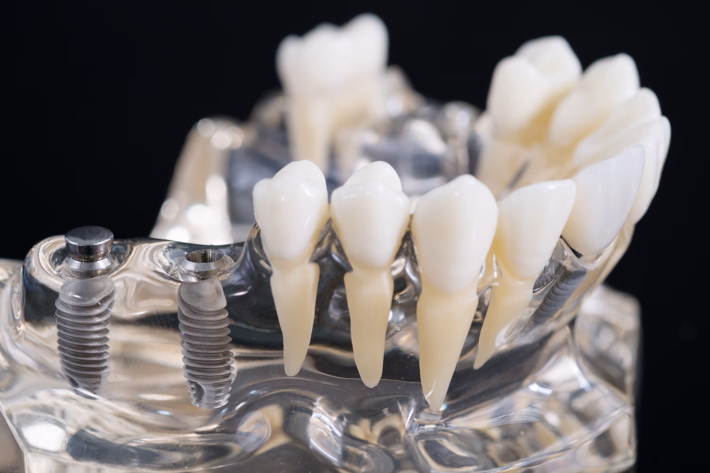 Zahnmodell mit zwei sichtbaren Zahnimplantaten und mehreren Zähnen auf transparentem Kunststoffgrund.