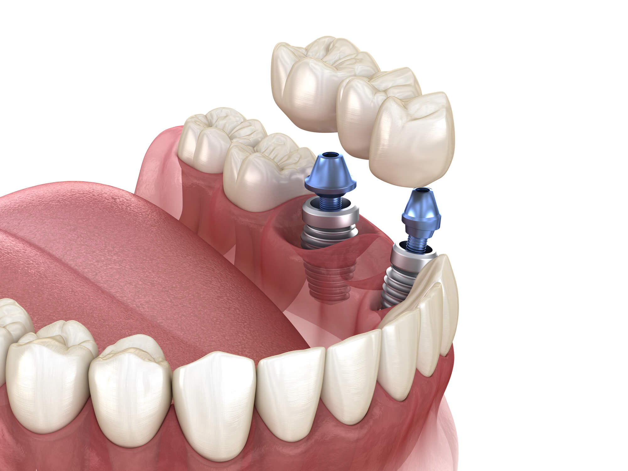 Illustration of dental implants with crowns positioned on top, showcasing the implant screws in a realistic gum and tooth structure.