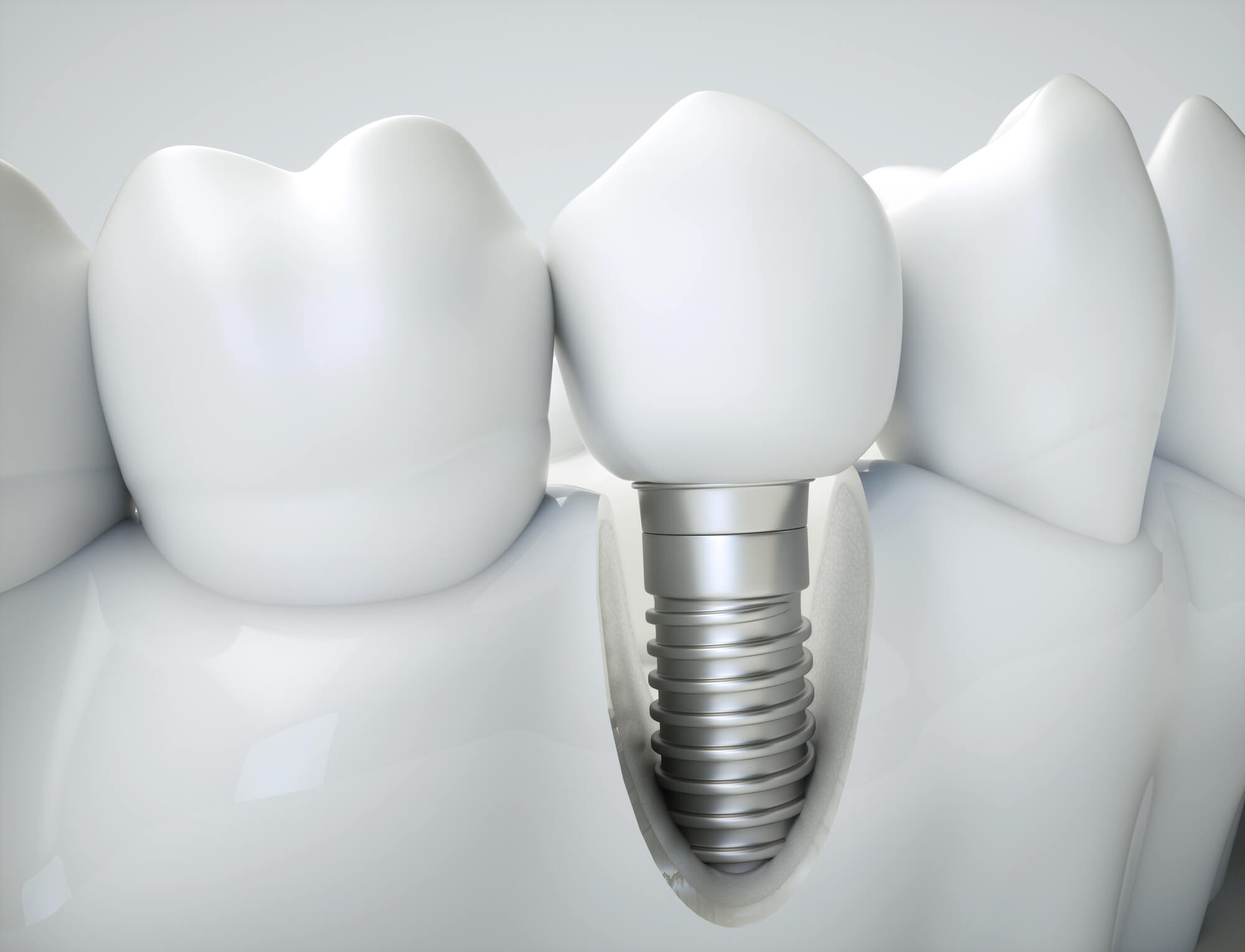 Close-up of a dental implant placed between natural teeth, showcasing the metal post and white crown.