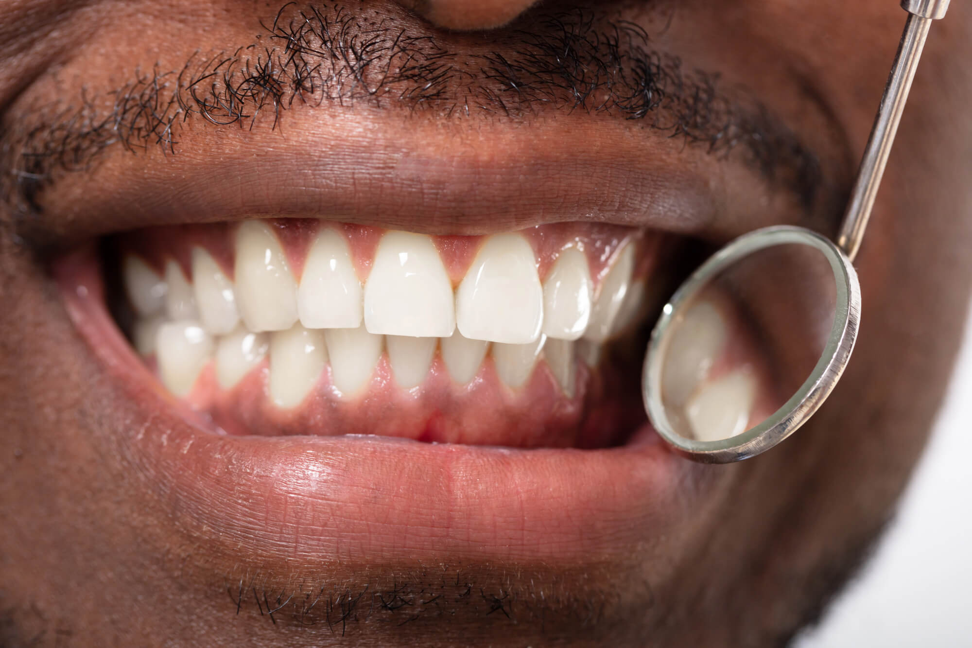 Close-up of a smiling man showing white teeth and visible gums, with a dental mirror reflecting in the image.