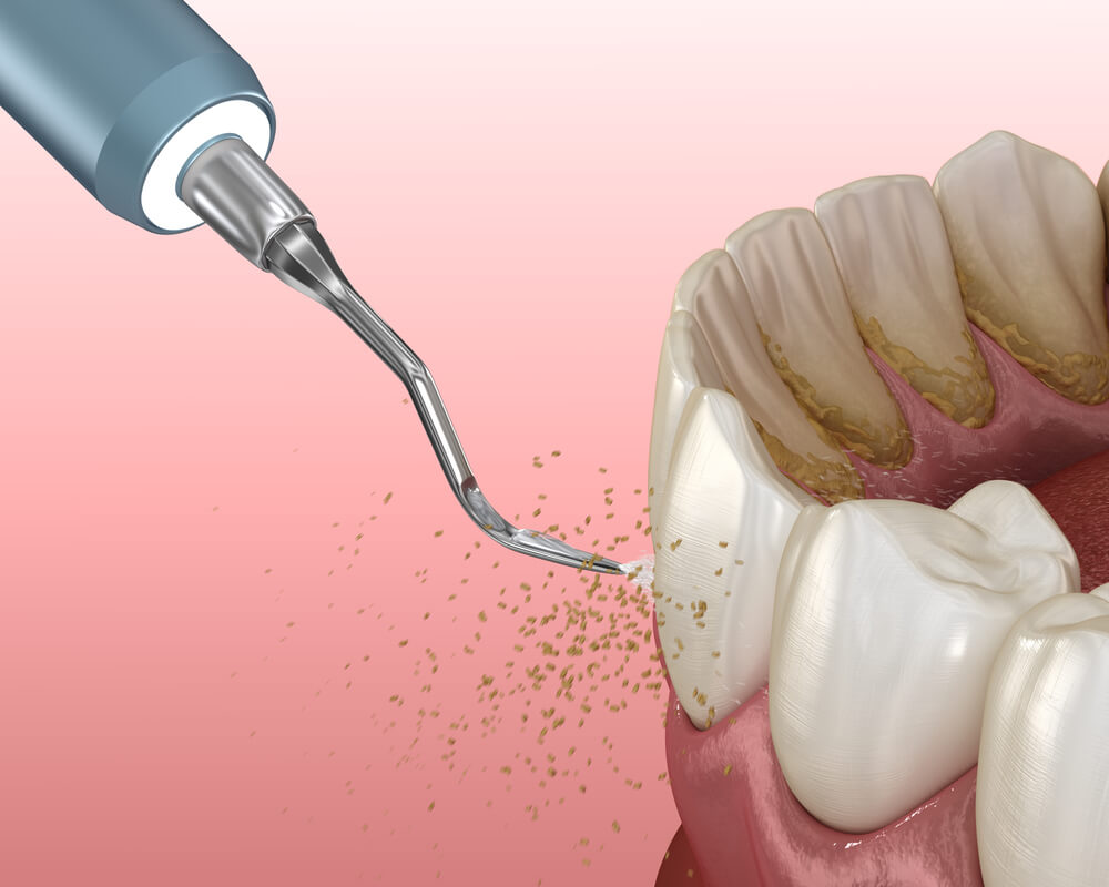 Illustration of a Dentist in Madison AL Removing Tartar