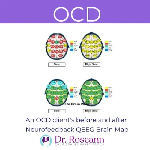 An OCD client experiences significant changes after a neurofeedback ocd brain map.