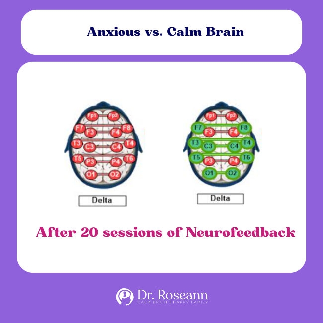 QEEG Brain Map and The Anxious Brain