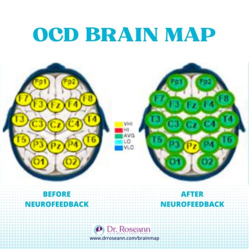 OCD Brain Map