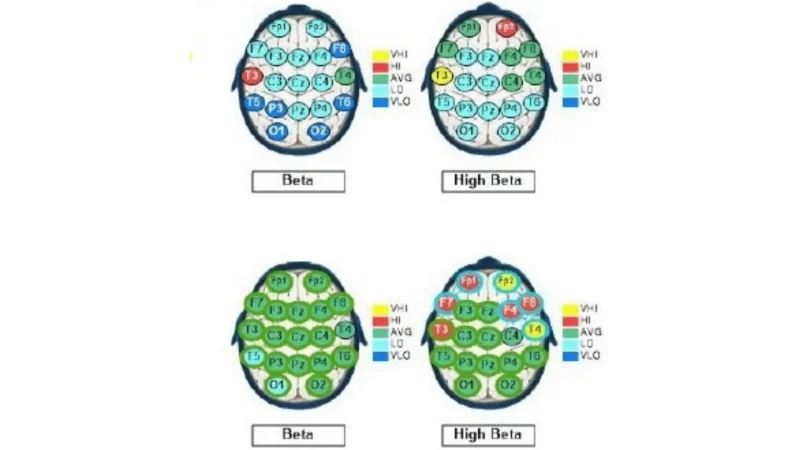 Ethan QEEG Brain Map