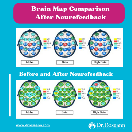 Normal Brain vs ADHD Brain QEEG Brain Map Dr. Roseann