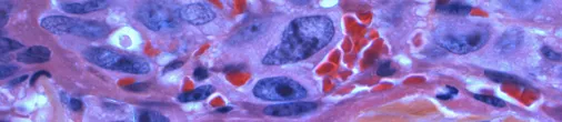 Microscopic view of stained cancer cells showing irregular shapes and varying sizes in purple and red hues.