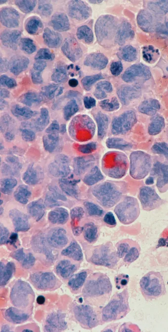 Microscopic view of stained cells showing round nuclei in various sizes with some cells containing bright red inclusions.
