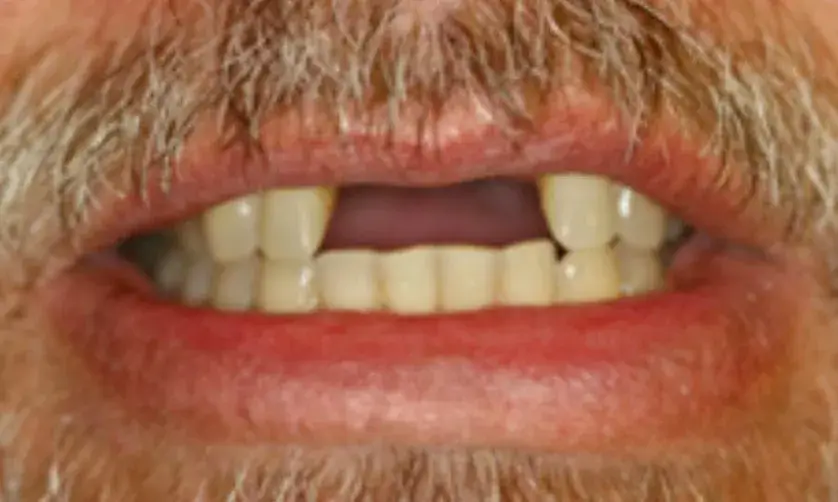 A man with a moustache is showing his teeth, missing an upper front tooth.