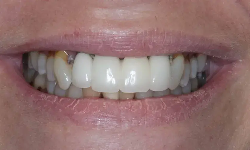 Close-up of a person's smile showing teeth with dental restorations.