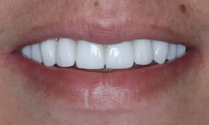 Close-up of a person smiling, showing clean, white teeth.