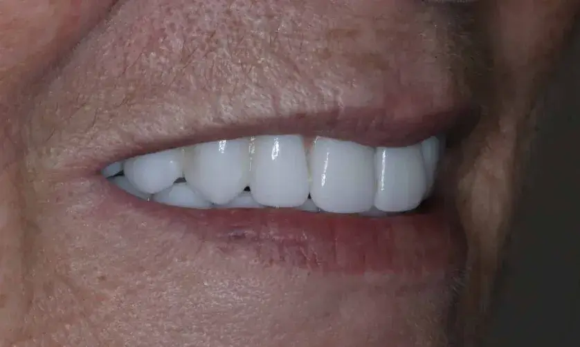 Close-up of a person smiling, showing bright, white teeth.
