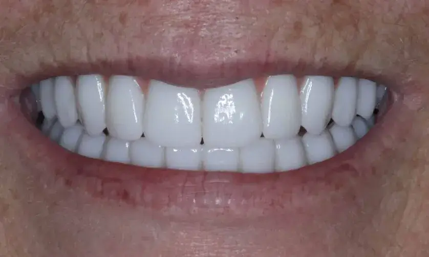 A close-up of a smiling mouth showing a set of bright, white teeth.