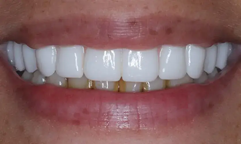 A close-up of a person smiling, showing white teeth with noticeable yellow plaque near the gums.