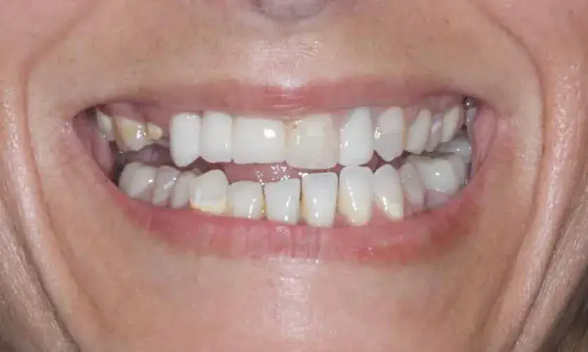 A close-up of a smiling mouth with natural teeth showing slight gaps and discoloration.
