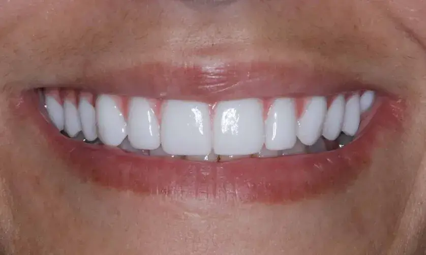 A person smiling with straight, white teeth visible.