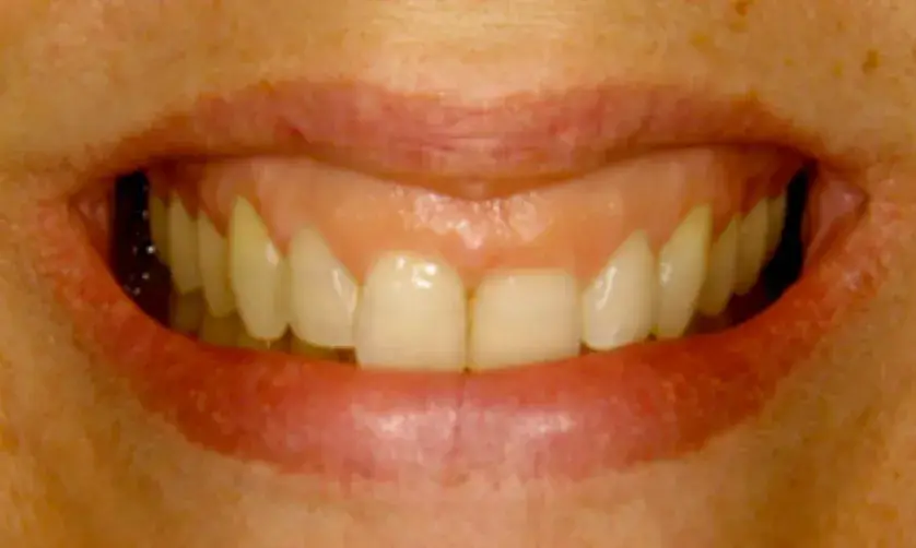 A close-up image of a person's smile showing their teeth and lips.
