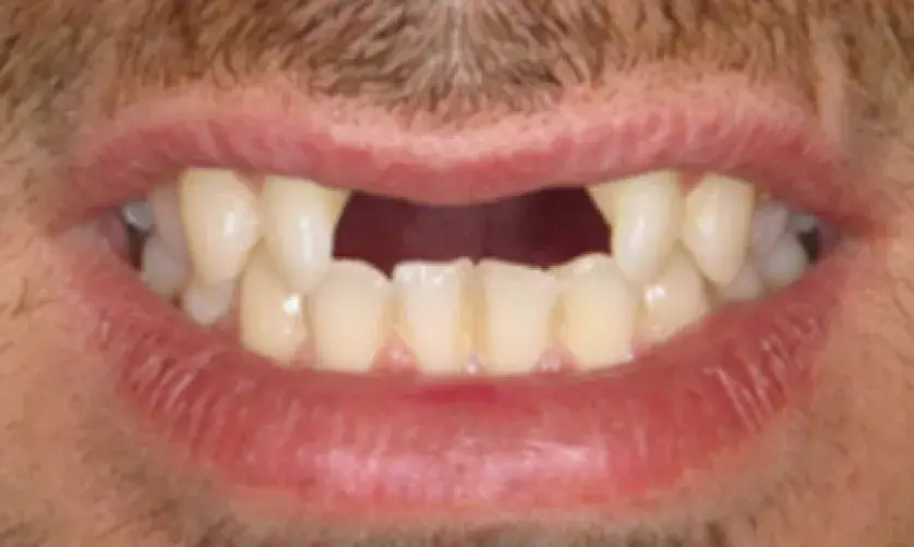 Close-up of a person's mouth showing a gap due to a missing front tooth.