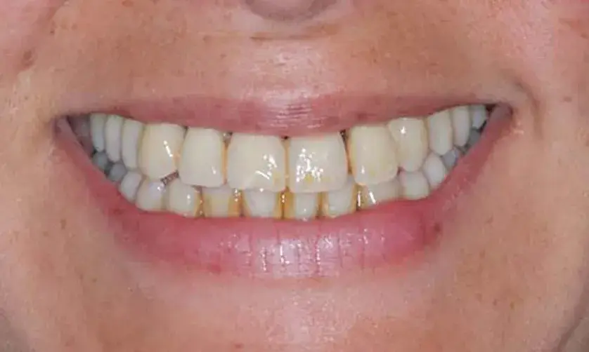 Close-up of a person's smile showing teeth with visible dental stains.