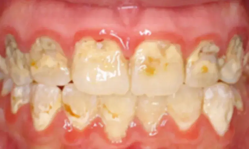 Close-up of decayed and stained teeth in an open mouth.