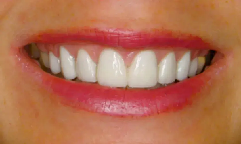 A person smiling, showing bright white teeth and wearing pink lipstick.