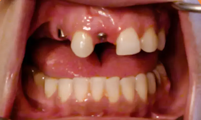 A close-up of an open mouth showing missing front teeth and dental implant posts.