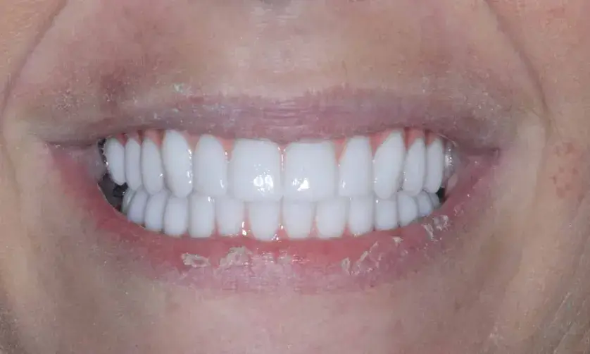 A close-up of a person smiling, showing clean, white teeth.