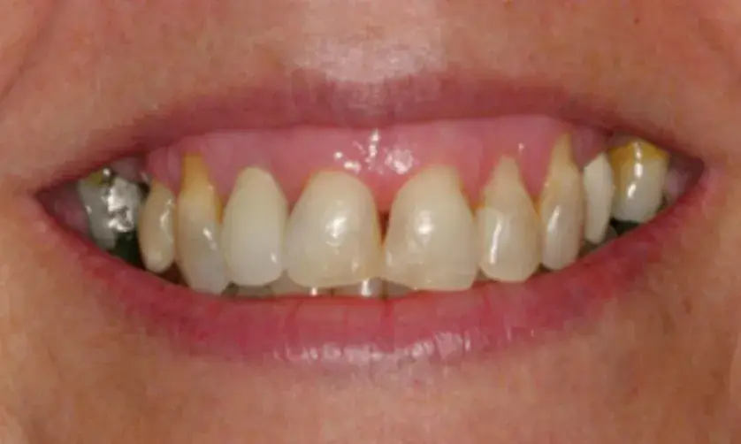 A person's mouth showing teeth with some discoloration and dental work visible.