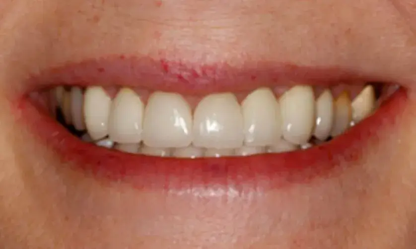 A close-up of a person smiling, showing their teeth.