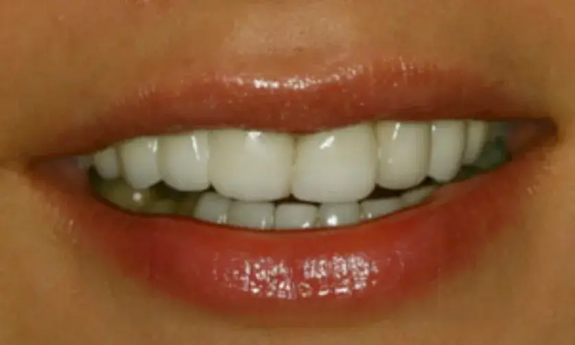 A close-up of a person smiling, showing white teeth and light pink lips.