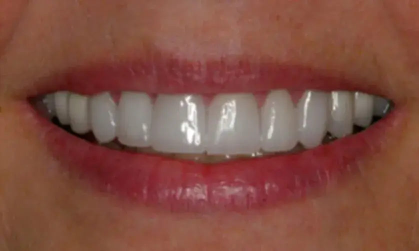 A person's mouth showing a smile with bright, even teeth.