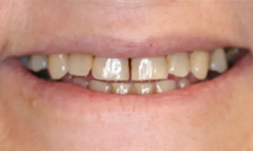 Close-up of a person smiling with visible chipped front teeth.