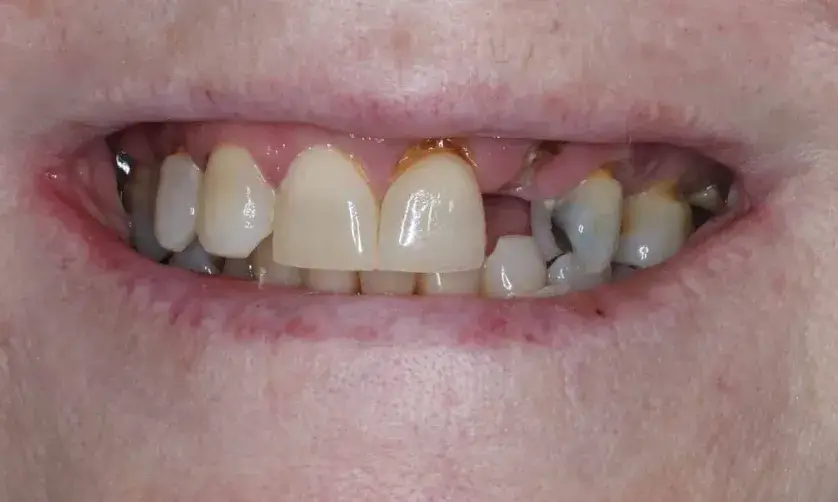 Person's mouth with several discolored and uneven teeth visible.