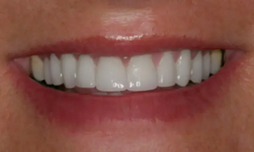 A person smiling, showing straight, white teeth.